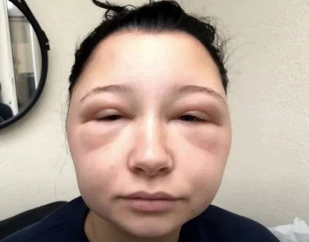 Marketten aldığı ürünle saçını boyadı: Kafası ampul gibi şişti! Yakınları bile tanıyamadı 13